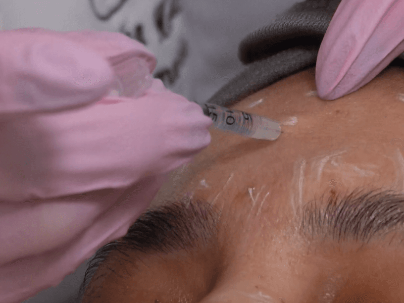 Resultado de Botox - caso 1