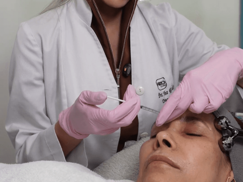 Resultado de Botox - caso 4