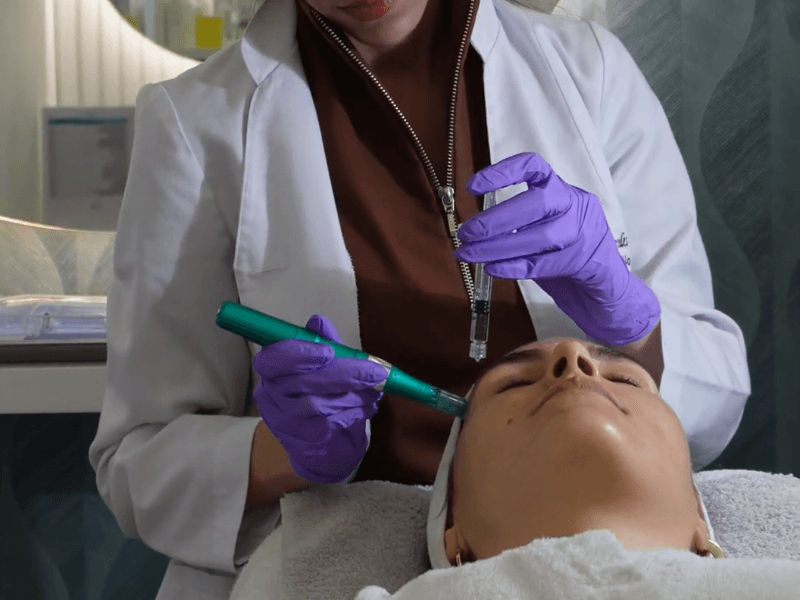 Resultado de Dermapen - caso 2