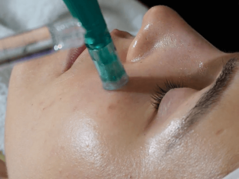 Resultado de Dermapen - caso 3