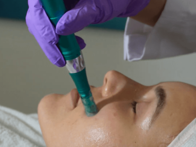 Resultado de Dermapen - caso 4