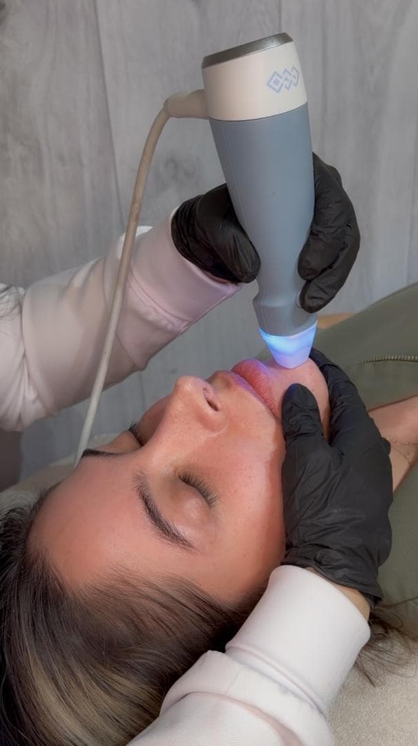 Láser Fraccionado con Microagujas (Exion)